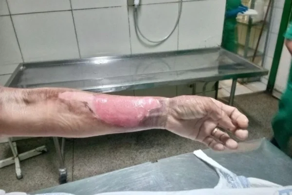 Vendedora de lanches esquece o registro do gás do fogão ligado, fogão explode e ela tem queimaduras em várias partes do corpo.