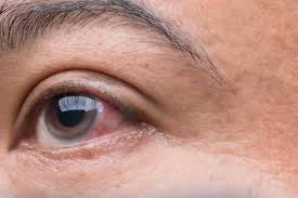 Oftalmologistas lançam campanha 24 Horas pelo Glaucoma.